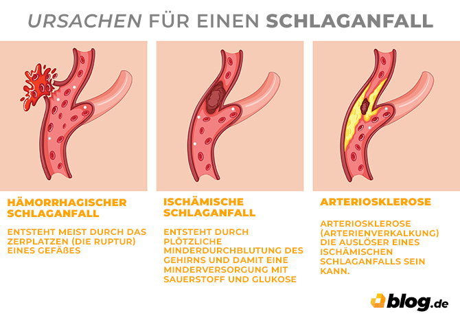 Infografik - Ursachen für einen Schlaganfall