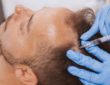 Haartransplantation