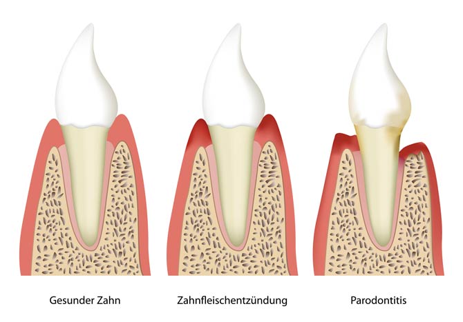 Parodontitis - Zahnbettentzündung