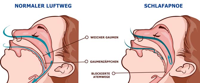 Schlafapnoe Schaubild