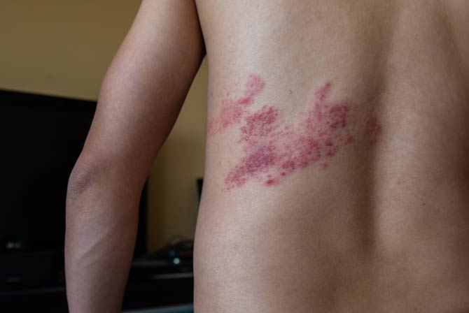 Herpes Zoster
