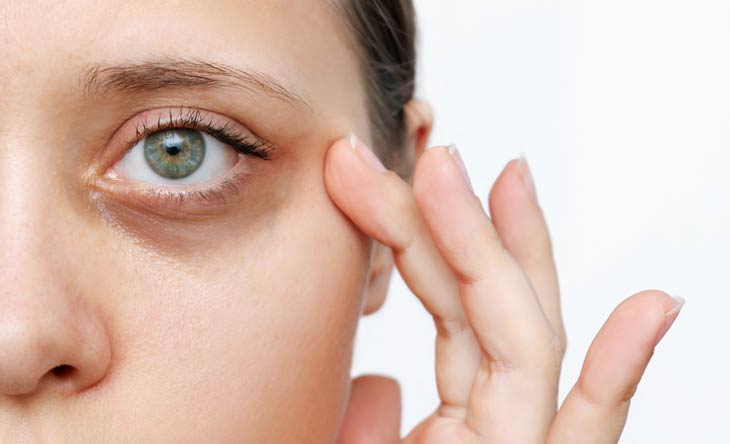 Tipps gegen Augenringe