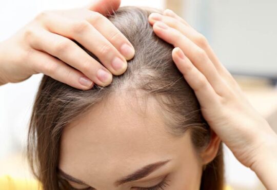 Haarausfall bei Frauen