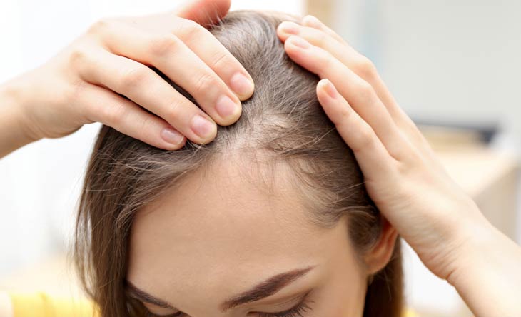 Haarausfall bei Frauen